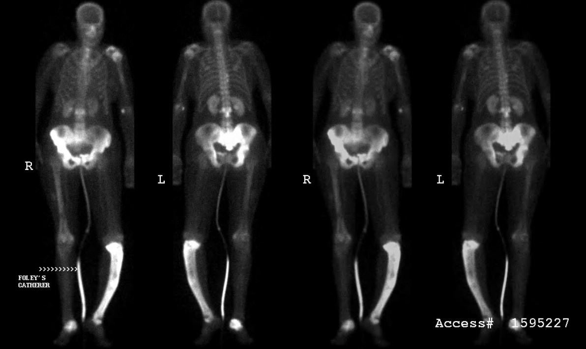 Figure 5 for case Pagets disease ( RID3815 )